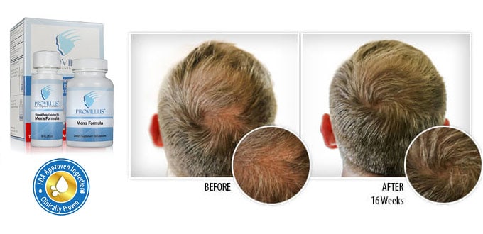 Provillus Receding Hairline Treatment For Men