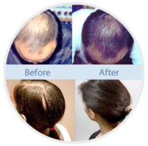 Provillus Before and After