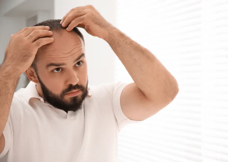 Can Stress Cause a Receding Hairline