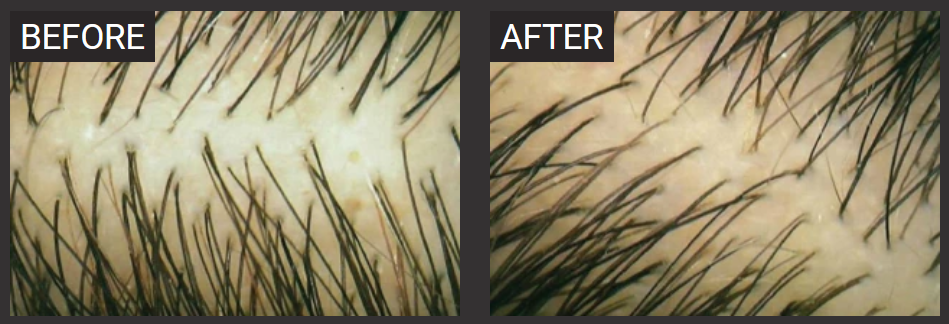 Folicerin Before and After Treatment