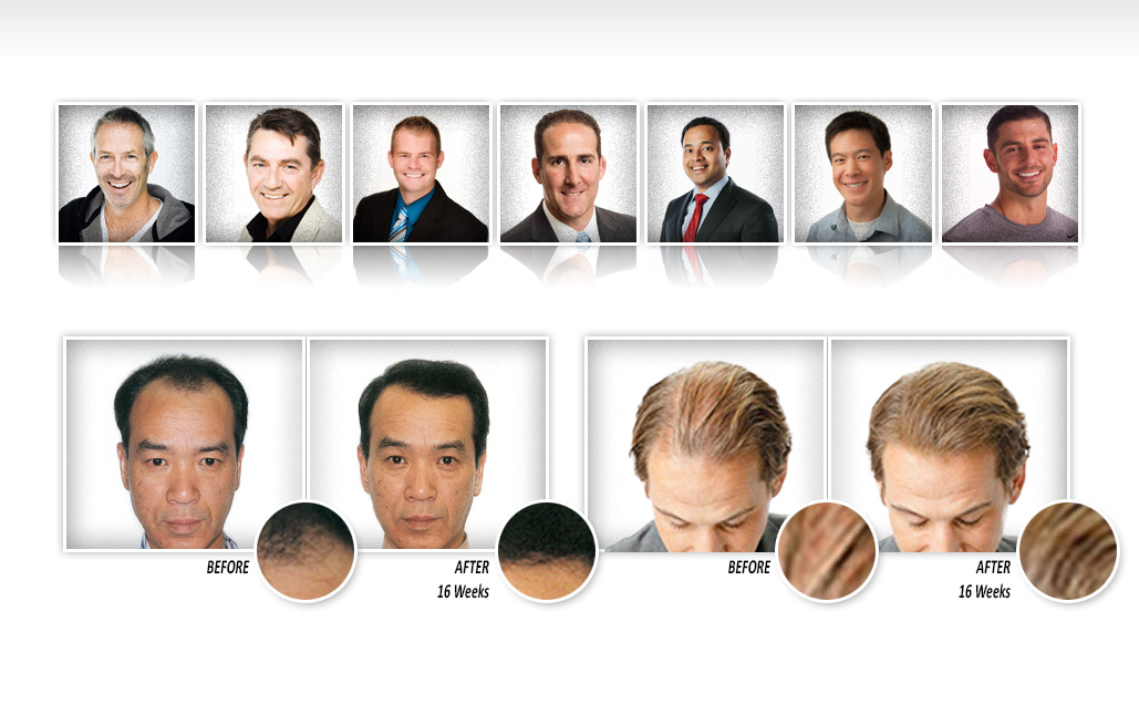 Provillus Before and After Men