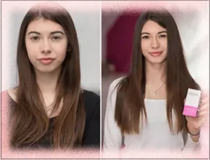 Ana Before and After using Locerin Ana Before and After Using Locerin Receding Hairline Treatment