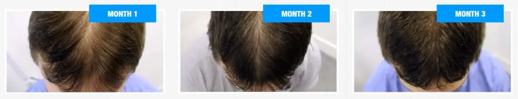 Before and After 3 months of use Profolan