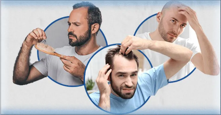 Picture of man who has to deal wit a receding hairline | How to Stop a Receding Hairline