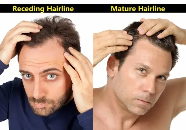Maturing vs Receding Hairline